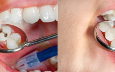 What Are the Benefits of White Fillings?