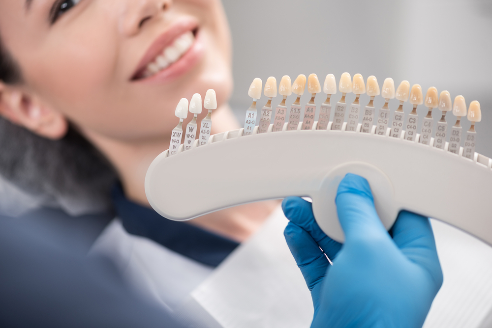 Are You a Good Candidate for Veneers?