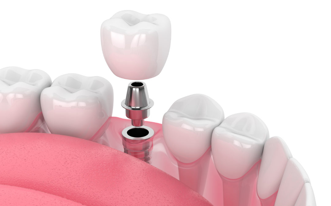 A Guide to Dental Implants