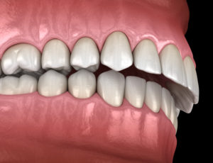 teeth with overbite