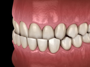 teeth with underbite