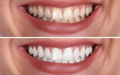 Why Do Teeth Stain? Causes and Long-Term Solutions for a Brighter Smile