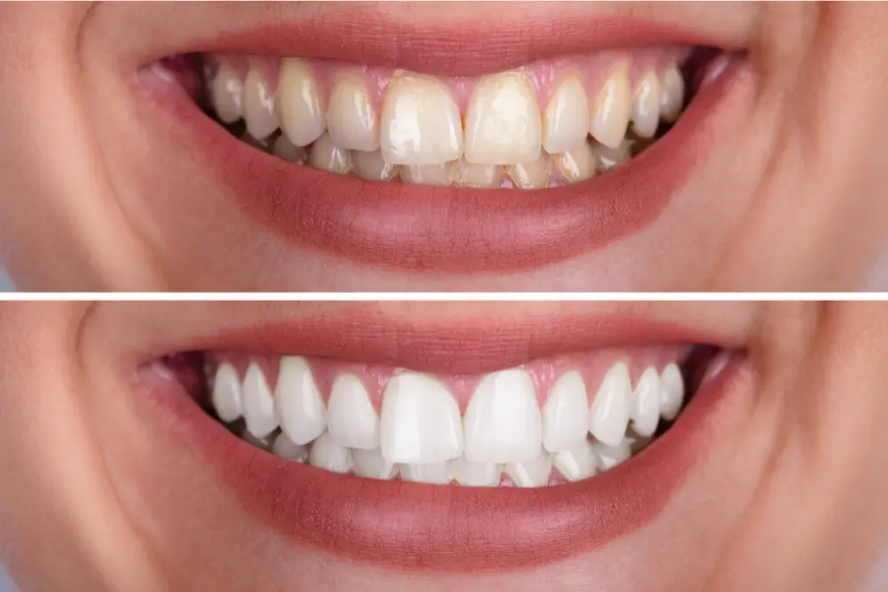 Why Do Teeth Stain? Causes and Long-Term Solutions for a Brighter Smile