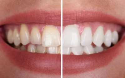 Intrinsic vs. Extrinsic Stains: Identifying Your Discoloration